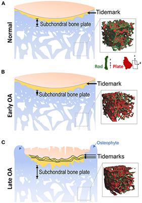 Subchondral Bone Remodeling: A Therapeutic Target for Osteoarthritis